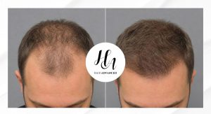 Alopecia Hombre, caída del pelo