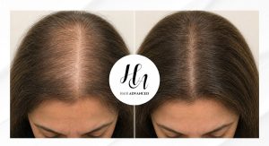 Alopecia Mujer. caída del pelo
